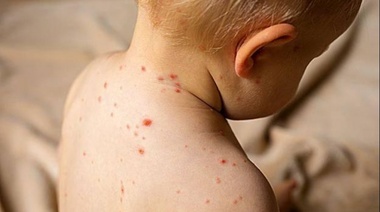 Sarampión: vacunación preventiva en los Centros de Salud de Varela