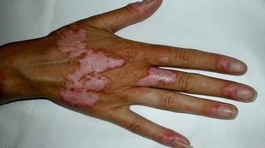 Qué es el lupus, la enfermedad autoinmune que padecen más de 22.000 argentinos