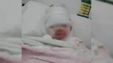Parte médico de Briana, la nena de 3 años quemada con aceite hirviendo en el Cruce Varela